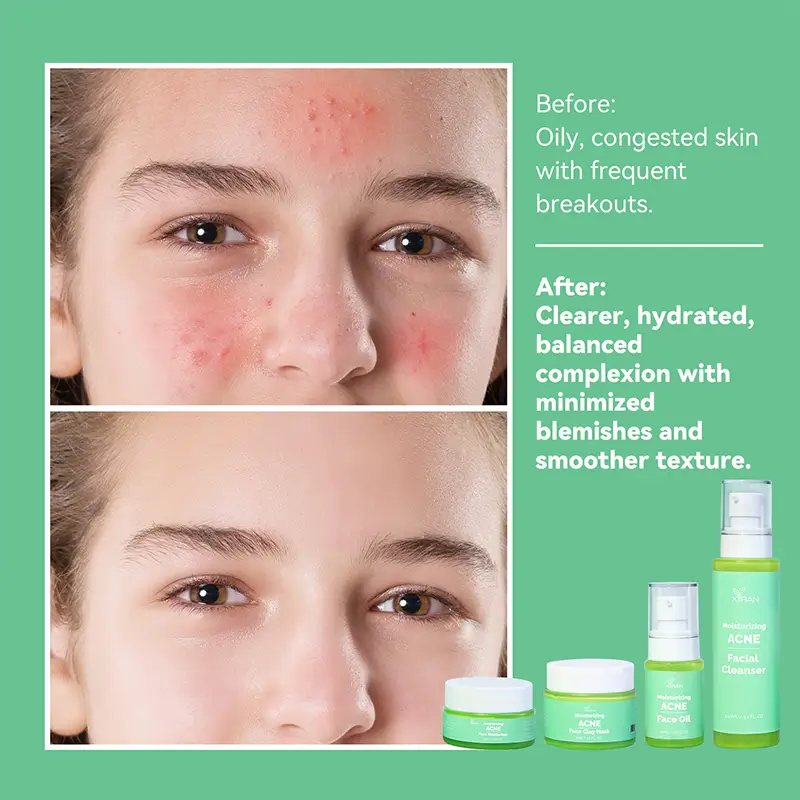 ACNE Skincare Set Before & After